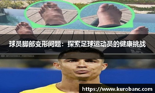球员脚部变形问题：探索足球运动员的健康挑战